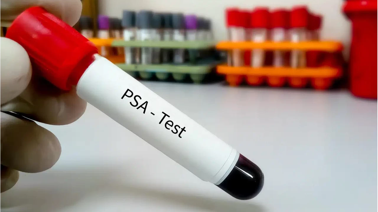 PSA Testi Nedir? Sonuçları Nasıl Yorumlanır?
