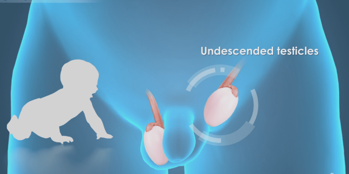 İnmemiş Testis (Kriptorşidizm) Nedir? Ne Zaman Ameliyat Gerekir?