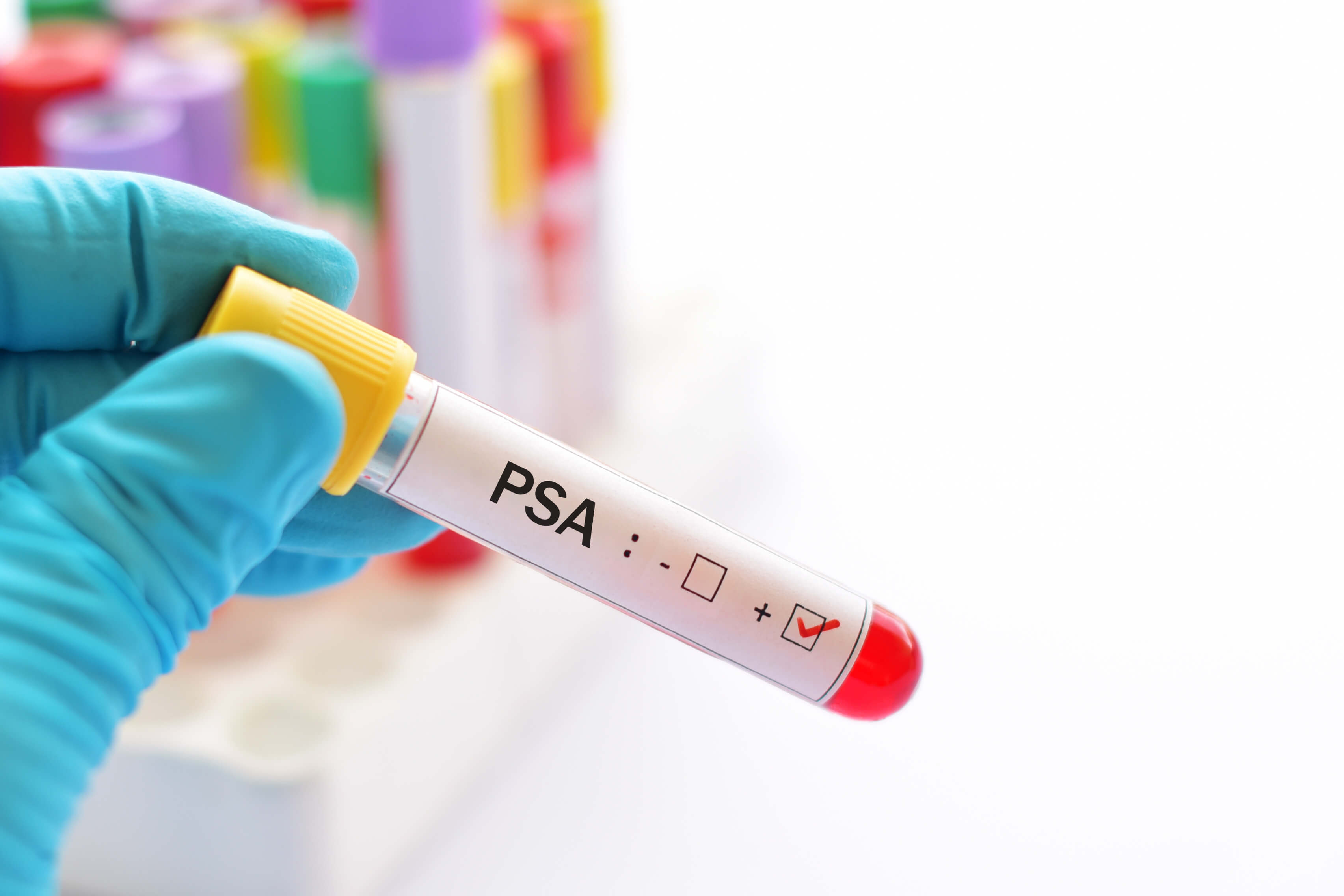 PSA Testi Nedir?