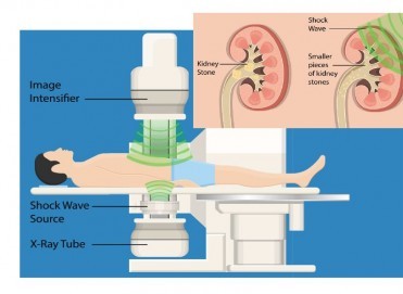 Ürolojide Lazerle Taş Kırma: ESWL Tedavisi Hakkında Bilmeniz Gerekenler