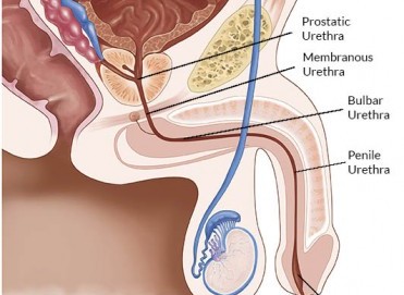 Erkeklerde Üretra Darlığı: Belirtileri, Tanı ve Tedavi Yöntemleri