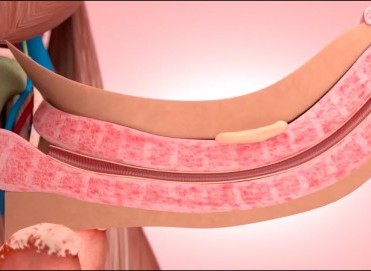 Peyronie Hastalığı Nedir? Penis Eğriliğinin Tedavisi