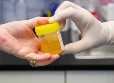 İdrarda Protein (Proteinüri) Bulunması Ne Anlama Gelir?