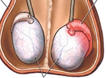Epididimit ve Orşit Nedir? Testis İltihabı Belirtileri ve Tedavisi