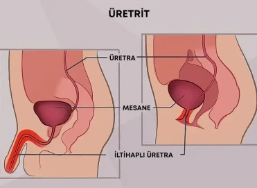 Üretrit Nedir? Belirtileri, Nedenleri ve Tedavi Yöntemleri