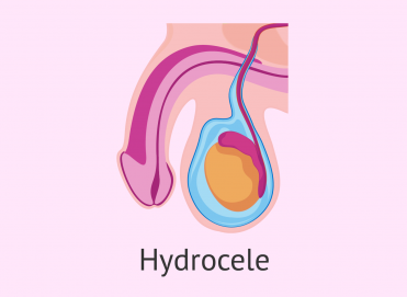 Hidrosel Nedir? Ameliyat Gerekir mi?