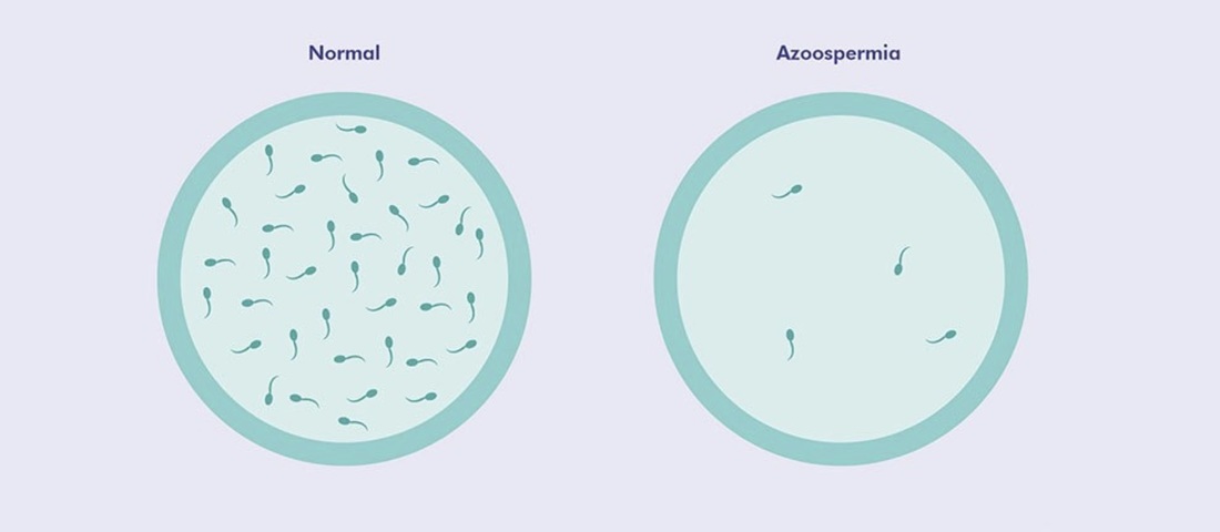Azospermi Nedir?