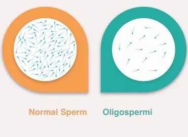 Düşük Sperm Sayısı (Oligospermi) Nedenleri ve Tedavisi