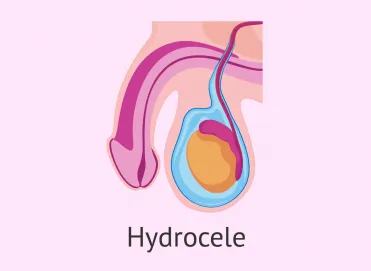 Hidrosel Nedir? Ameliyat Gerekir mi?