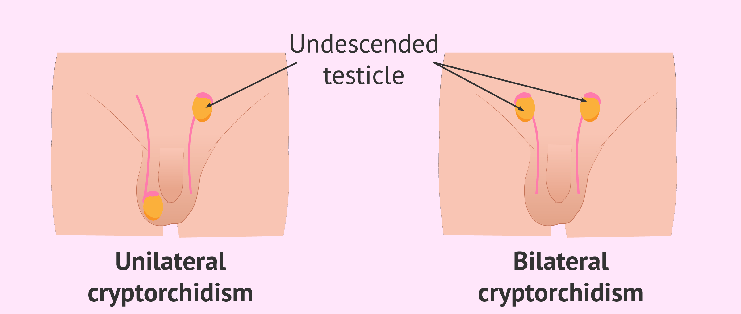 Kriptorşidizmin Yetişkinlikteki Etkileri: İnmemiş Testis Sorunu