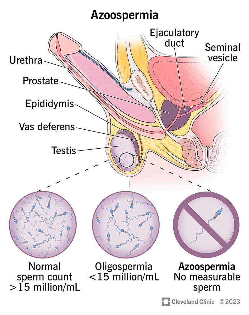 Azoospermi Nedir? Sıfır Sperm Sayısında Tedavi Seçenekleri
