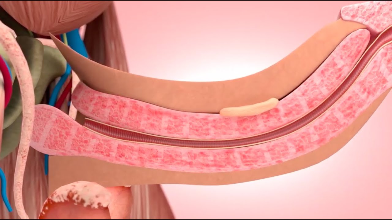 Peyronie Hastalığı Nedir? Penis Eğriliğinin Tedavisi