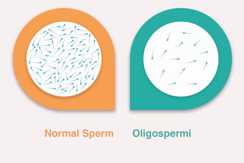 Düşük Sperm Sayısı (Oligospermi) Nedenleri ve Tedavisi